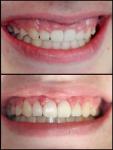 lasergingival3_fs